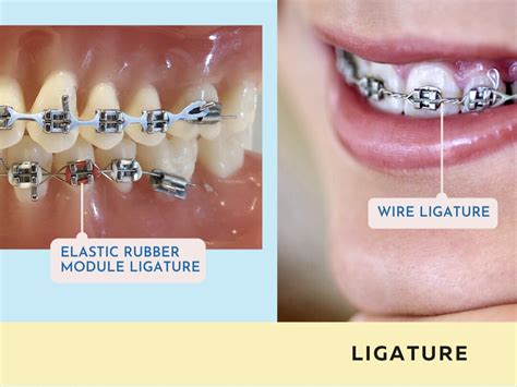 dental wire with metal brackets|thin braces wire.